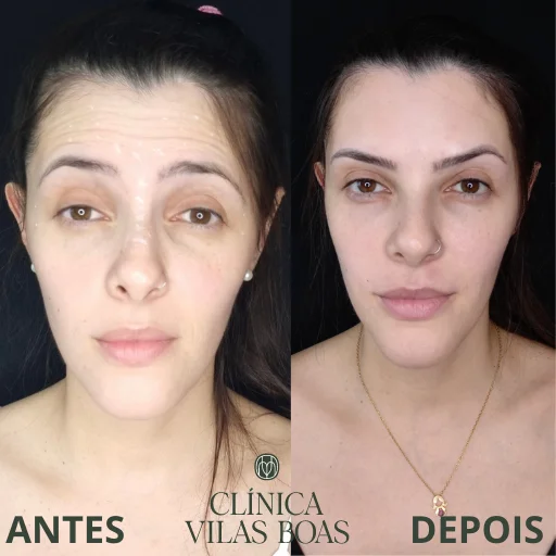 Botox (3)