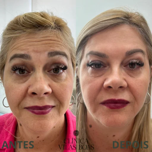 Botox (4)
